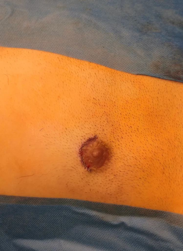 Accesso periareolare nella chirurgia della ginecomastia