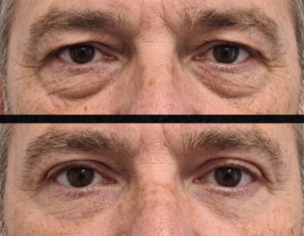 Blefaroplastia valencia mirada