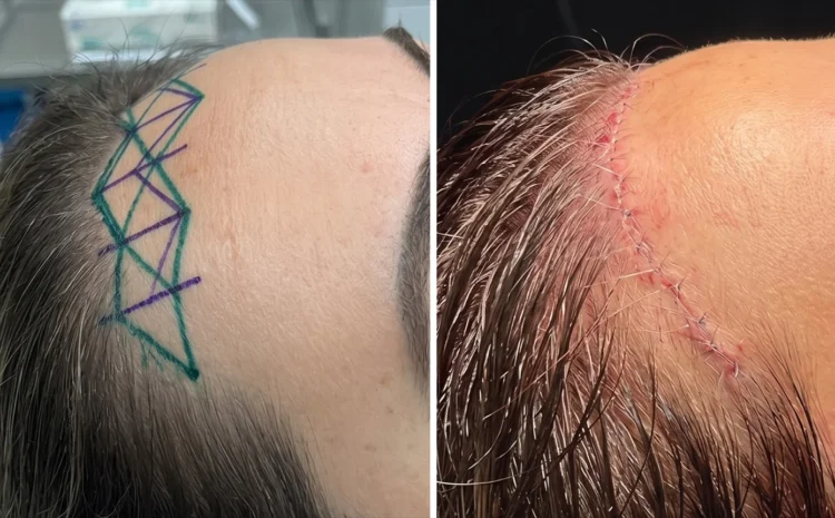 Forehead reduction in Valencia