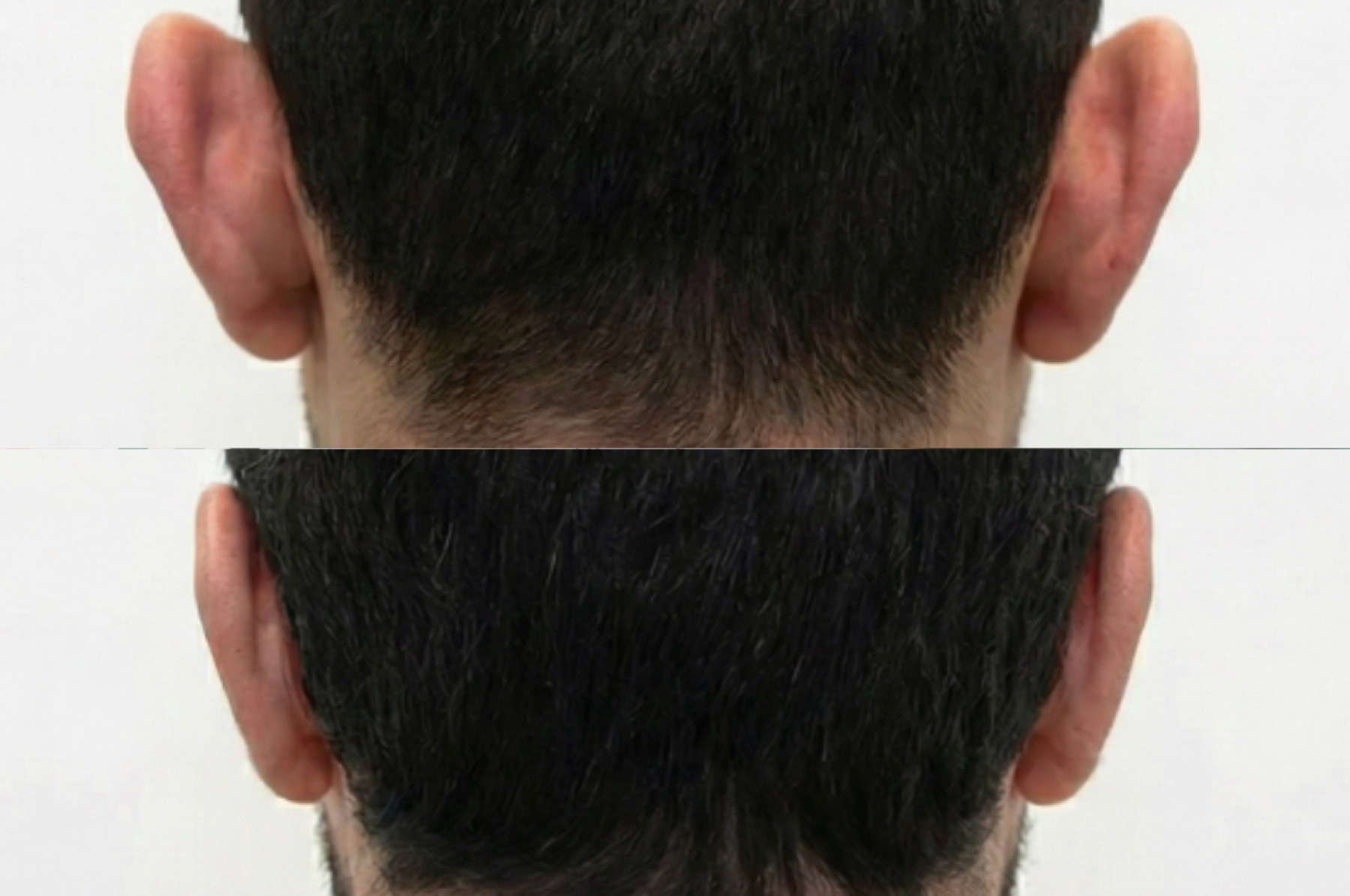 Otoplastia vista posterior