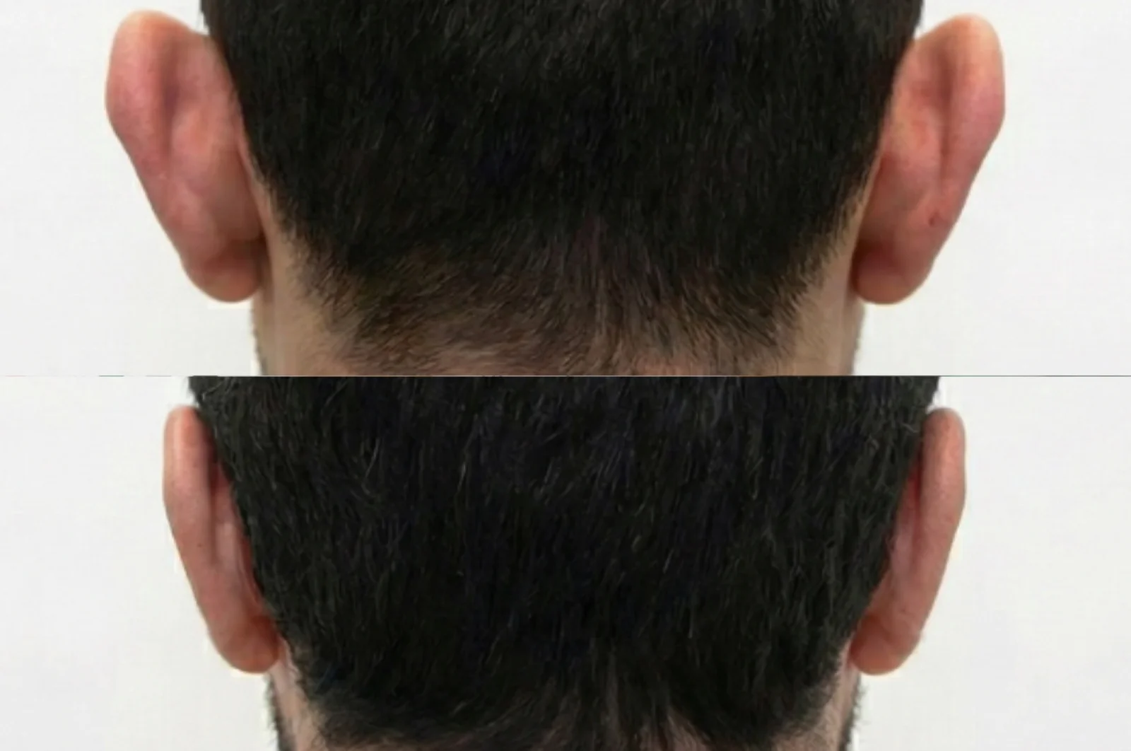 Otoplasty, posterior view