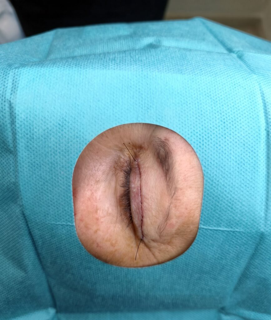 Sutura blefaroplastia
